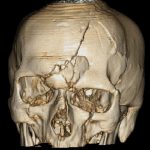 В Днепре нейрохирурги воссоздали разбитый череп. Новости Днепра