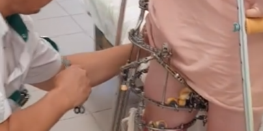 В Днепре девочке удлинили ногу более чем на 13 сантиметров: видео