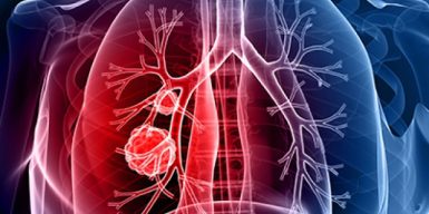 Програму реімбурсації розширено двома препаратами проти хронічних обструктивних захворювань легень