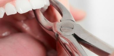 Від чого залежить ціна на видалення зуба?